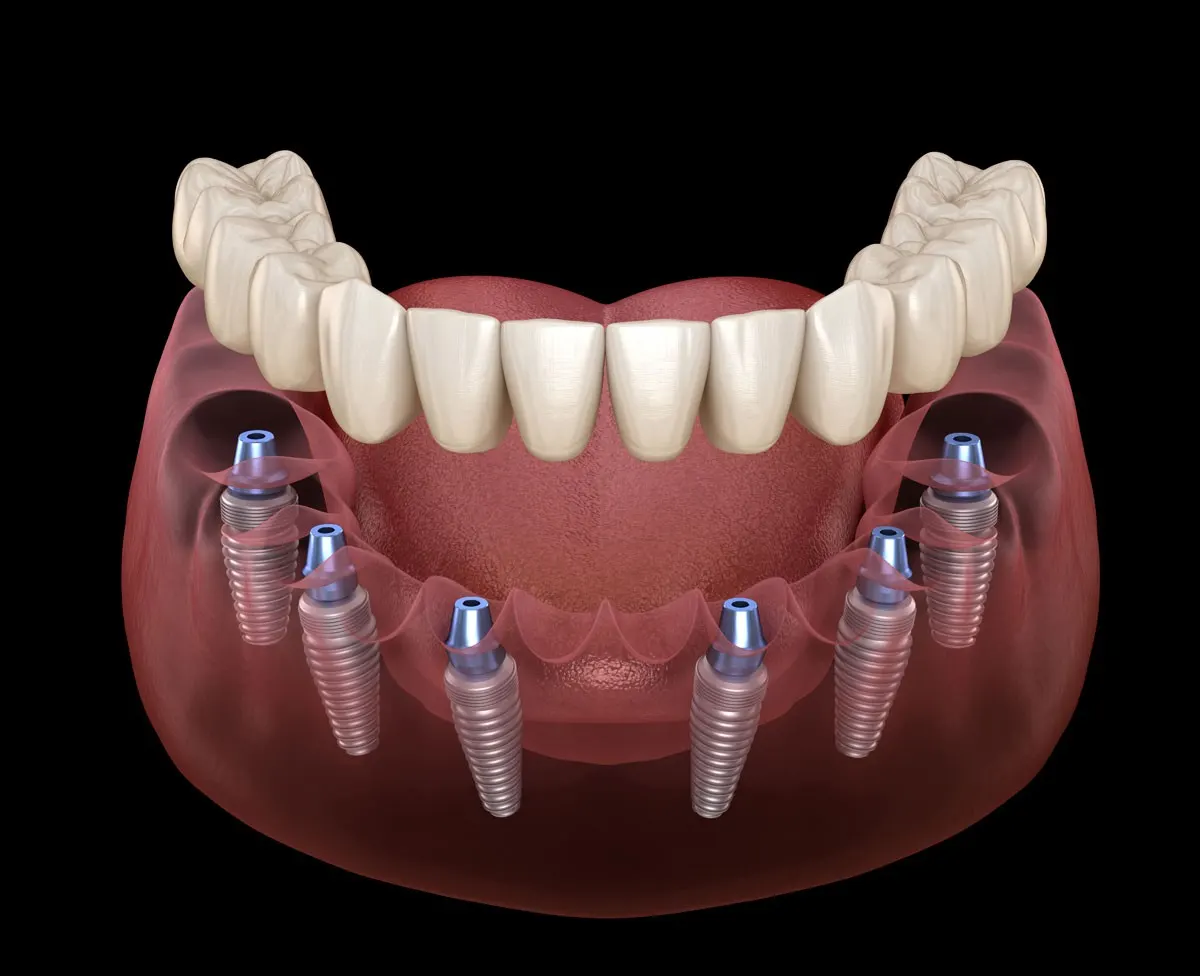 Six implant full arch system