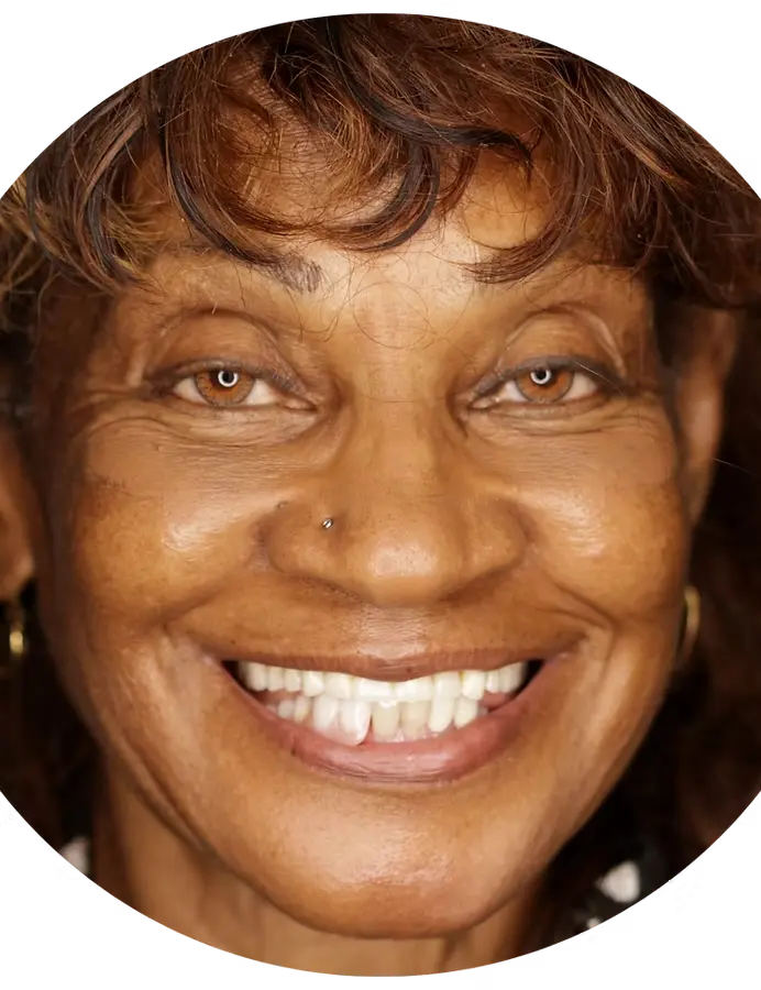 Patient 4 before full mouth dental implants
